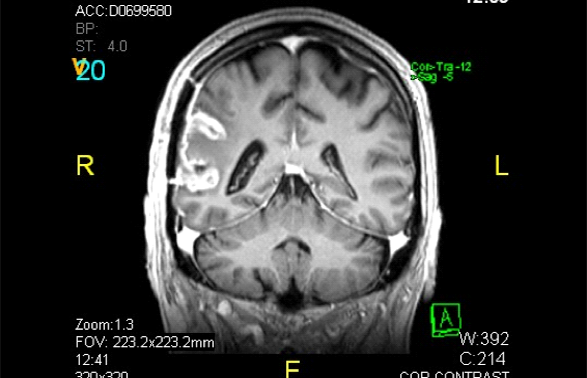 Gliovac before treatment